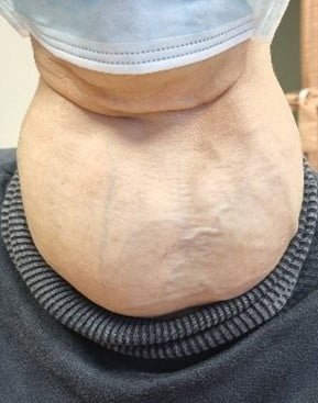patient with thyroid nodule