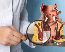 Anorectal Conditions Guide