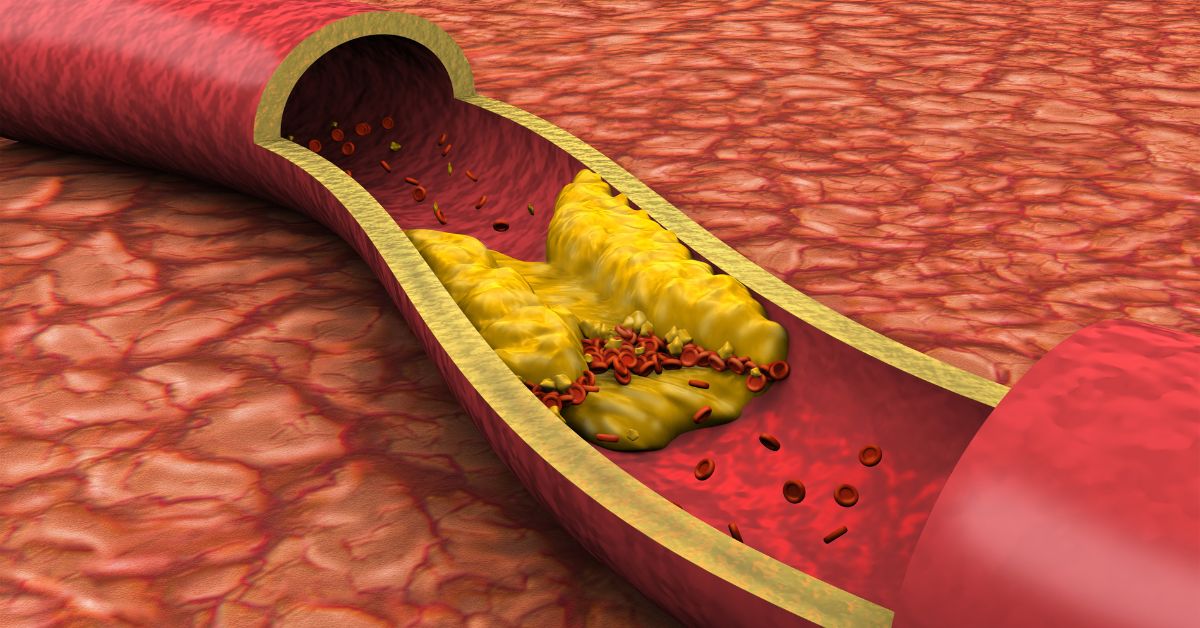 coronary artery disease
