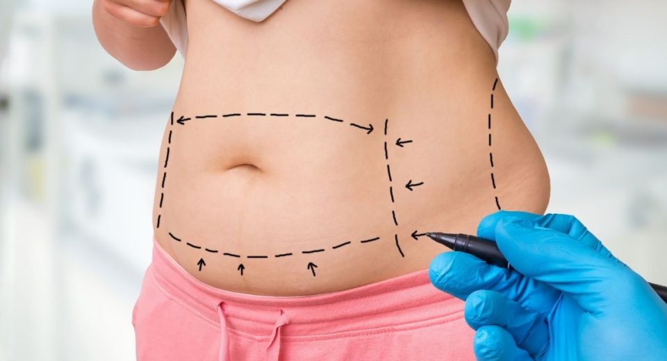 Liposuction Singapore vs Weight Loss Surgery