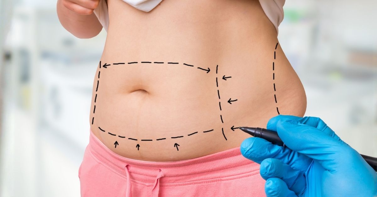 Liposuction Singapore vs Weight Loss Surgery