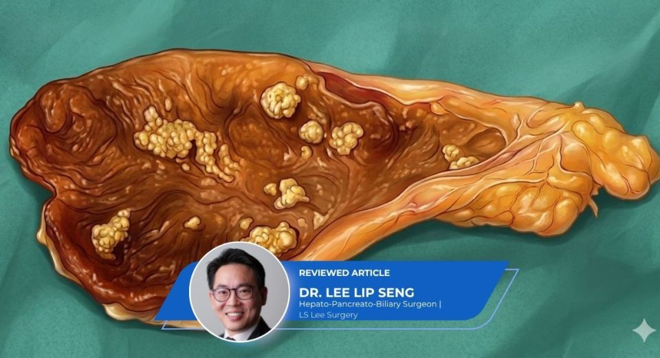 Gallbladder Polyps