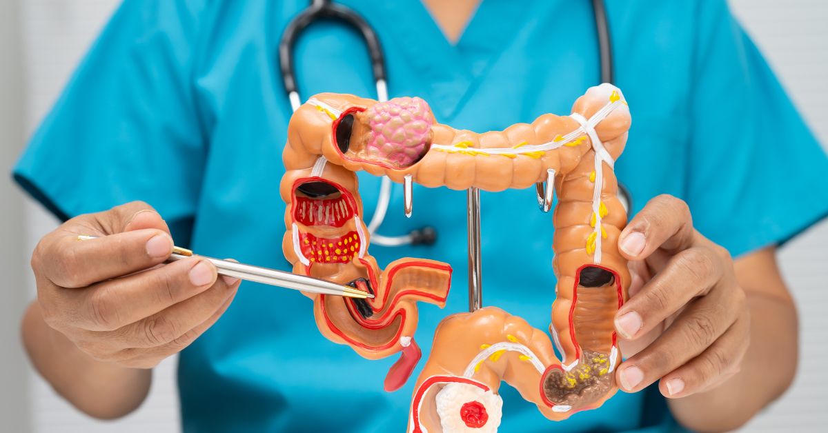 Colorectal Polyps The Big Story