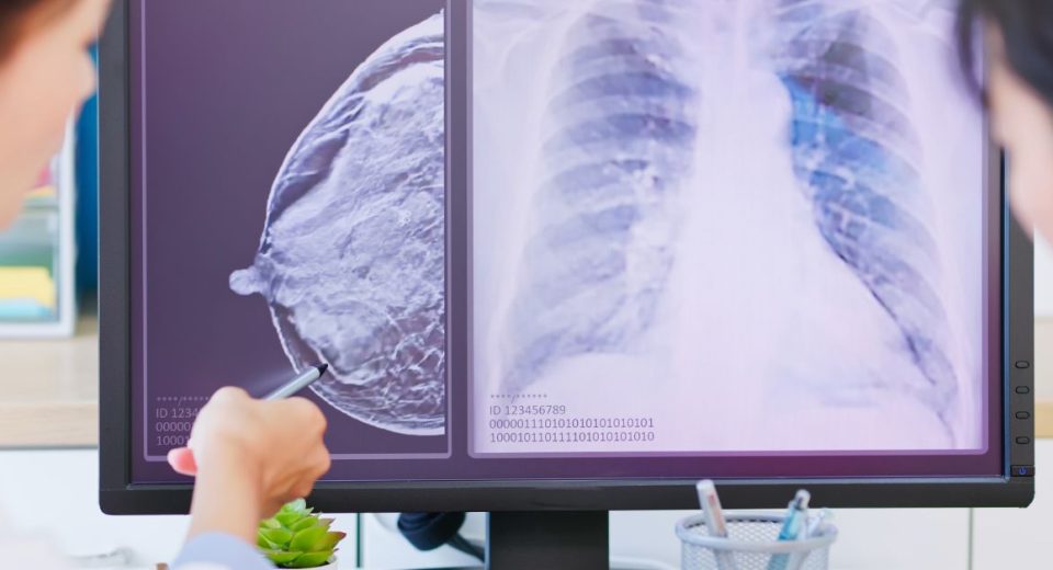 Breast Cancer Surgery in Johor