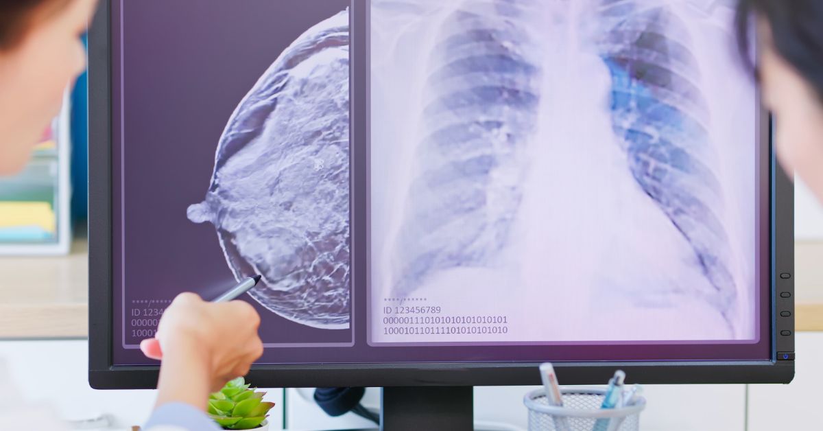 Breast Cancer Surgery in Johor