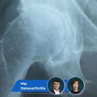 Hip Osteoarthritis Guide keyart