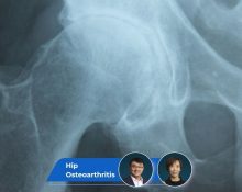 Hip Osteoarthritis Guide keyart