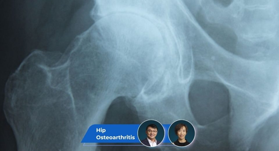 Hip Osteoarthritis Guide keyart