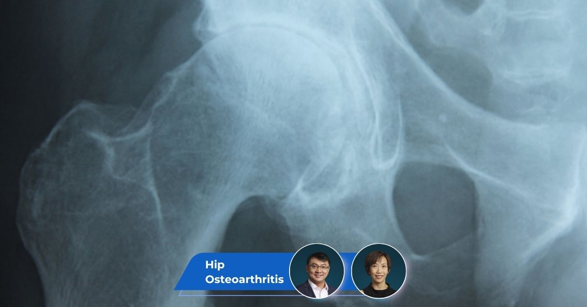 Hip Osteoarthritis Guide keyart