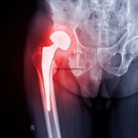 Hip Osteoarthritis