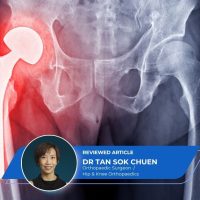 Direct Anterior Hip Replacement