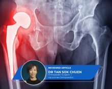 Direct Anterior Hip Replacement