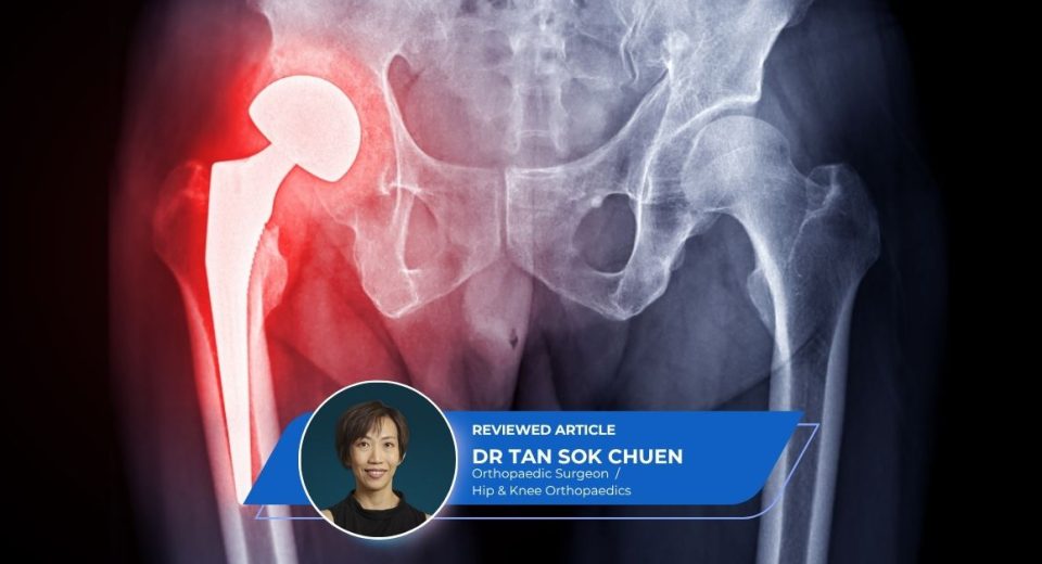 Direct Anterior Hip Replacement