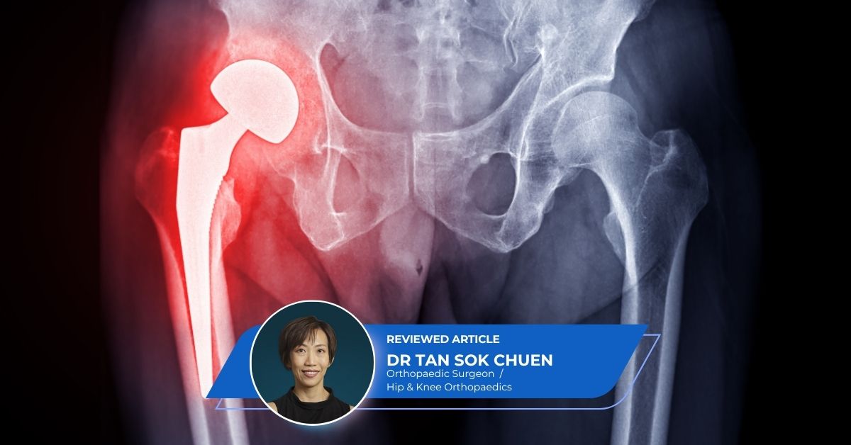 Direct Anterior Hip Replacement