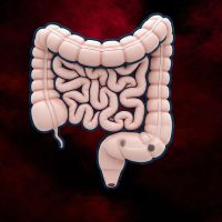 Large colon polyps