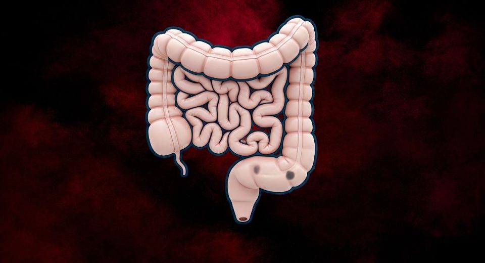Large colon polyps