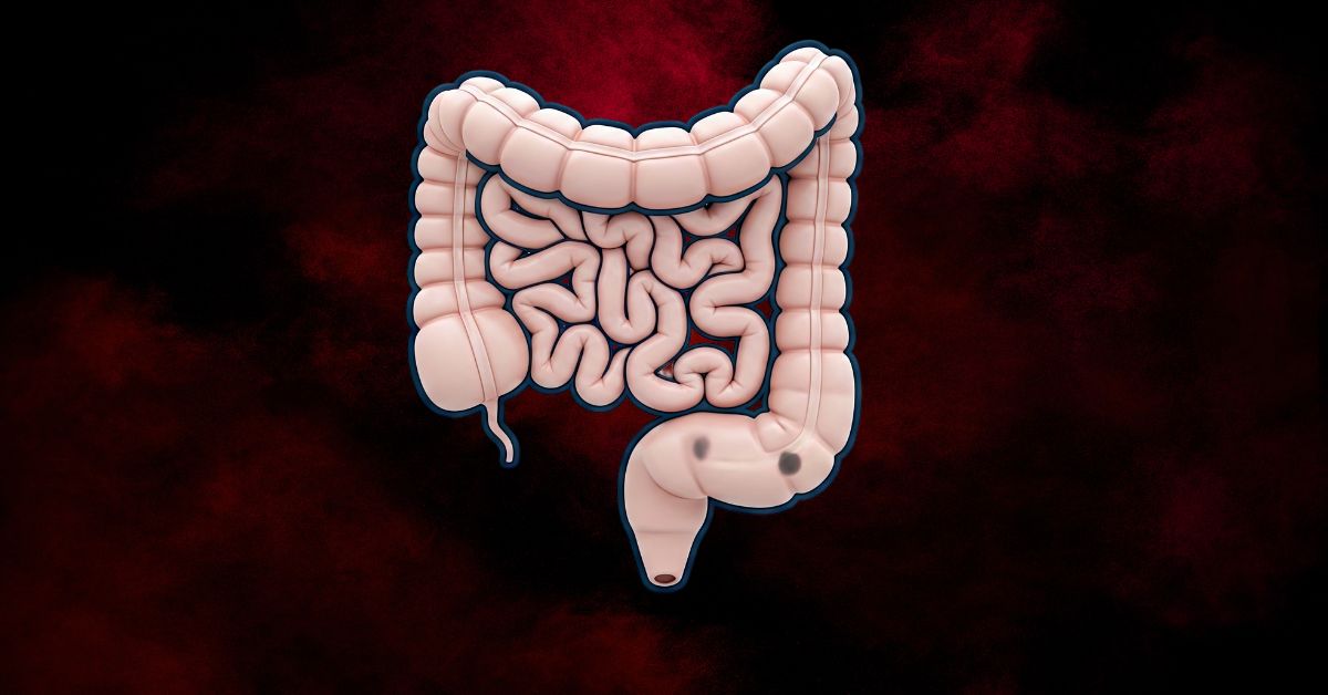 Large colon polyps