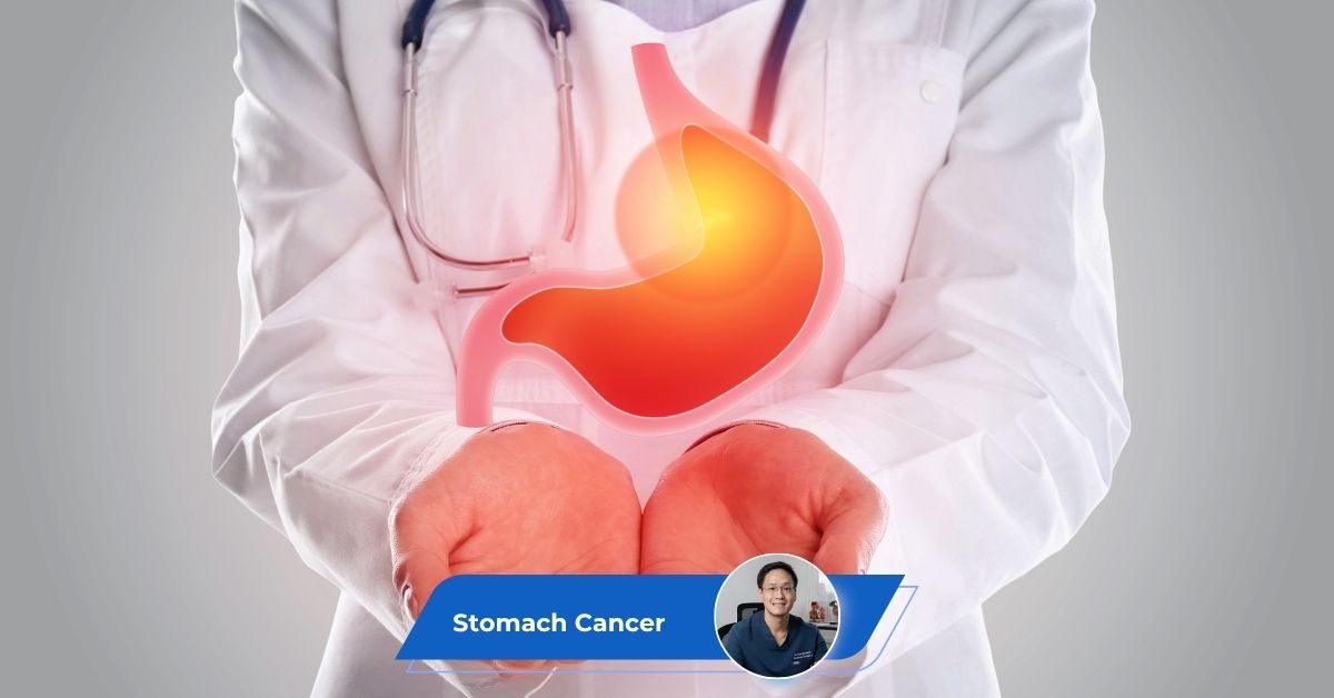Stomach Cancer Guide Keyart